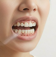 Dentiste tooth decay